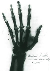 Aufnahme 14.02.1896, Handverletzung durch Schrottflinte